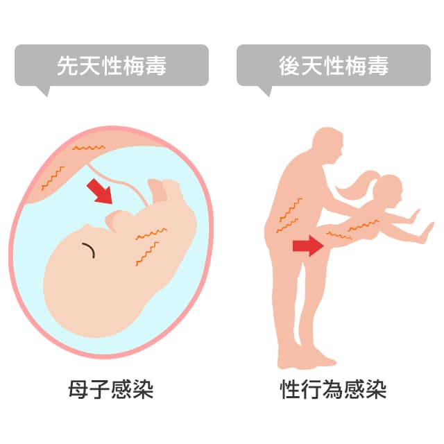 梅毒の感染経路妊娠中の母子感染と性行為がある